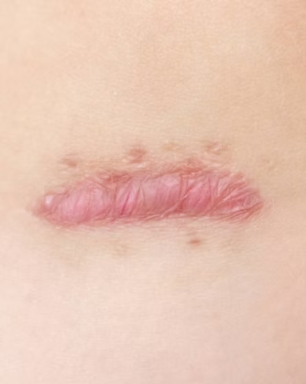 image cicatrices médecine anti-âge