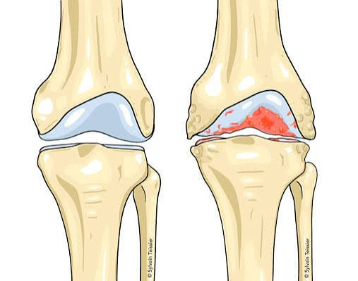 tendinites et arthrose